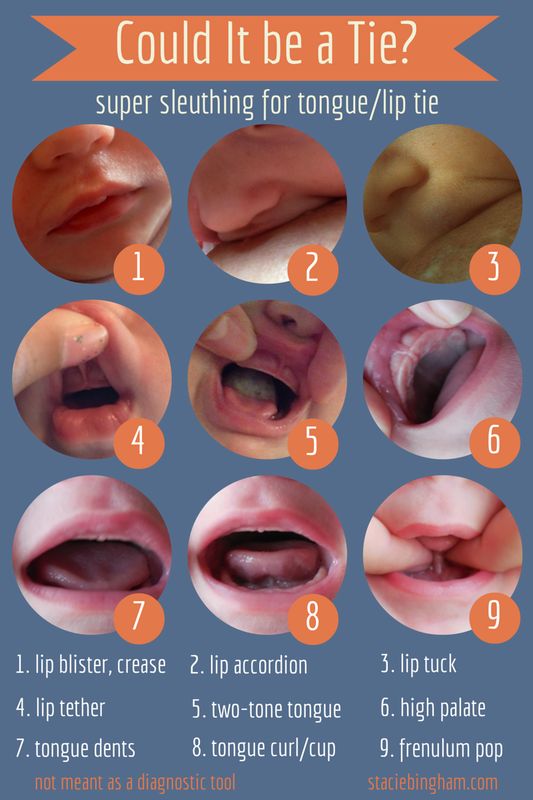 Lip and Tongue Ties: How to check for one, Revision Tips, and Post-Revision  Aftercare - Meghan Birt